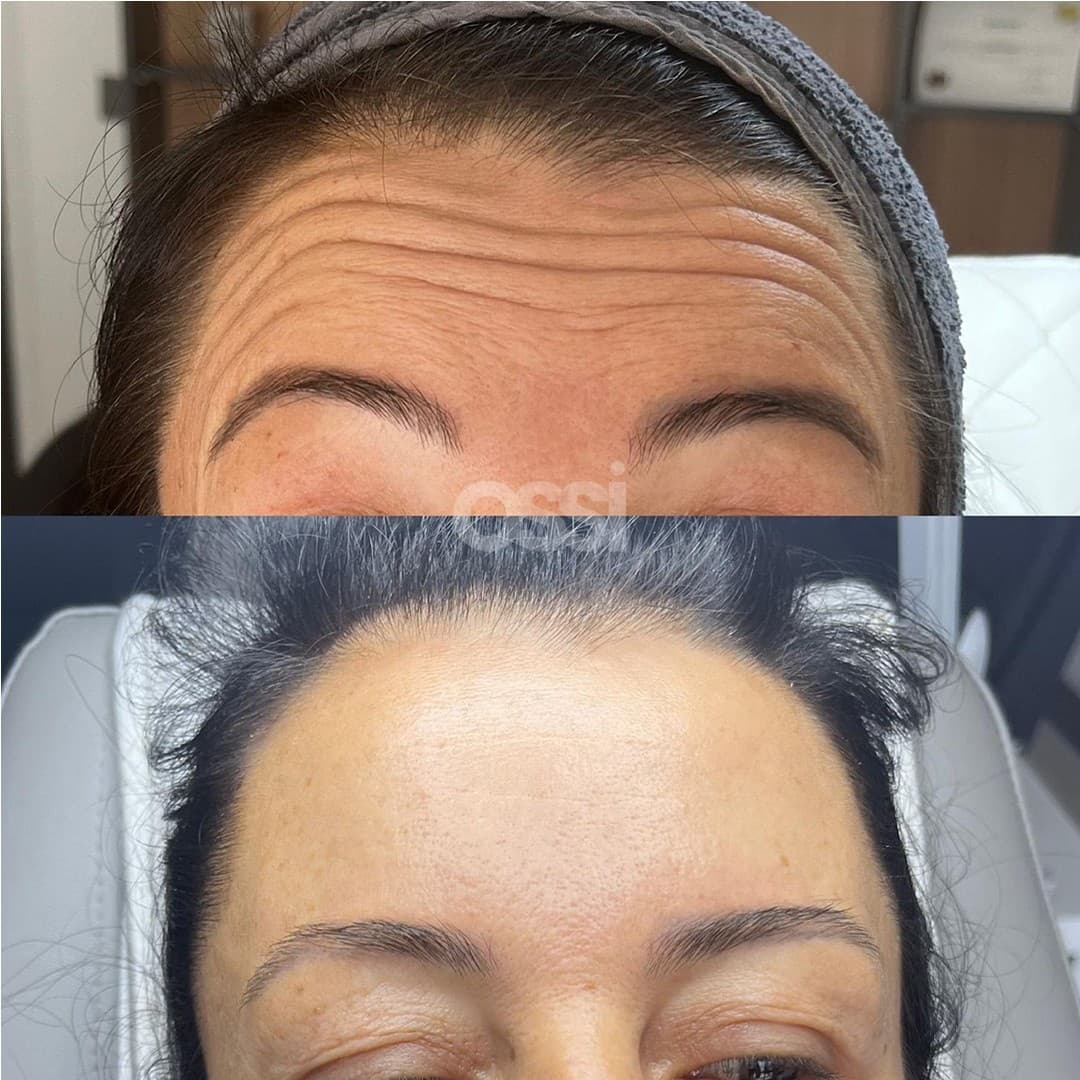 Botox Case 1