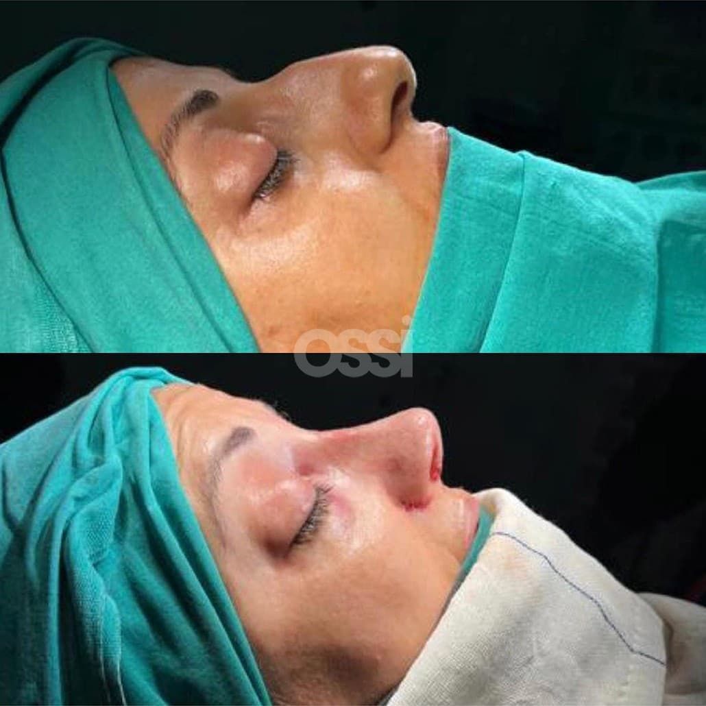 Rhinoplasty Case 1