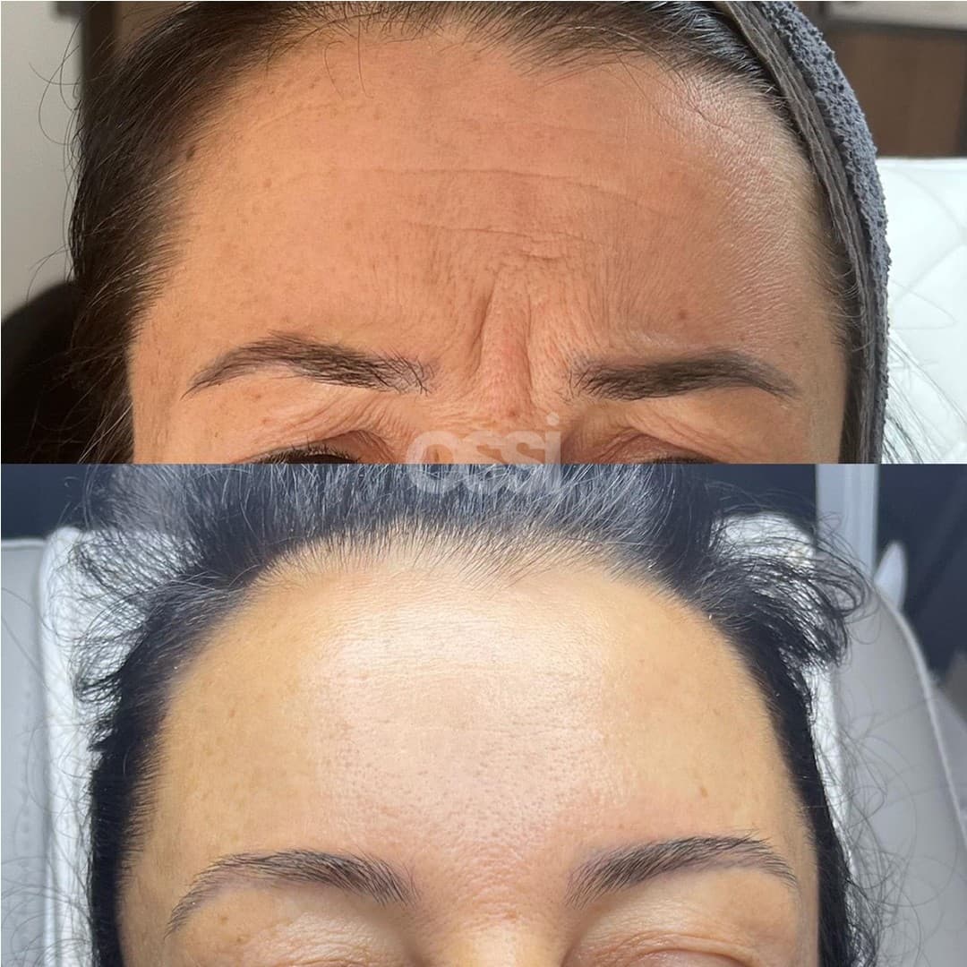 Botox Case 2