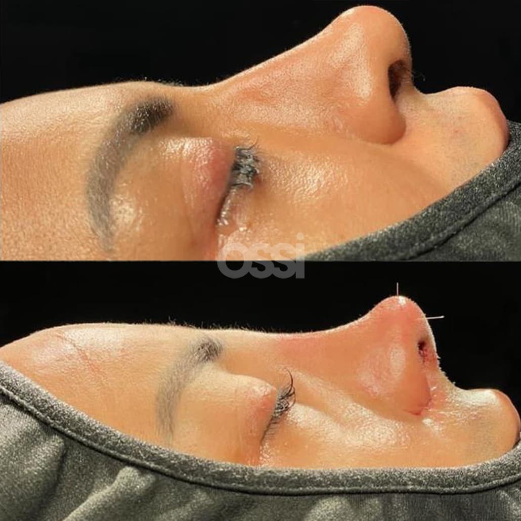 Rhinoplasty Case 2