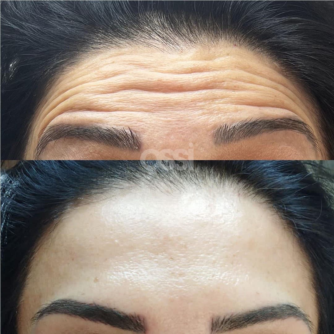 Botox Case 3
