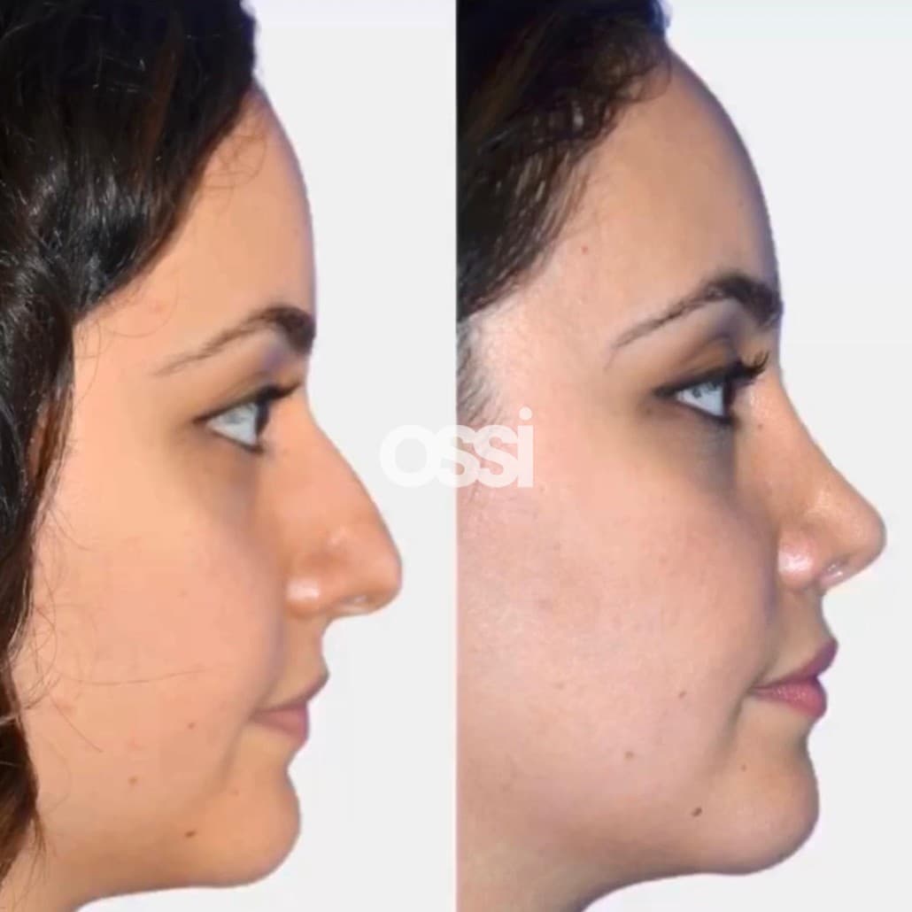 Rhinoplasty Case 3
