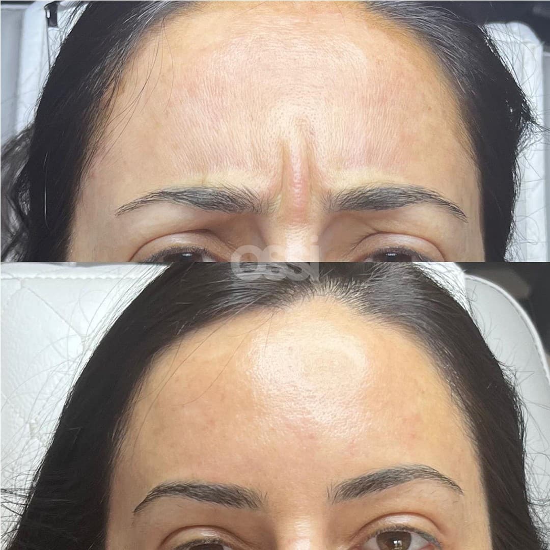 Botox Case 4