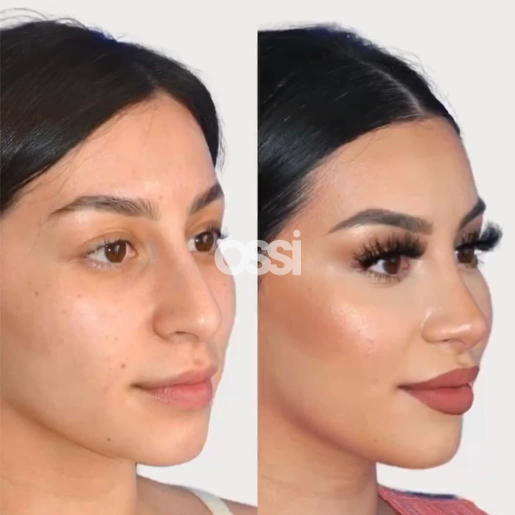 Rhinoplasty Case 4