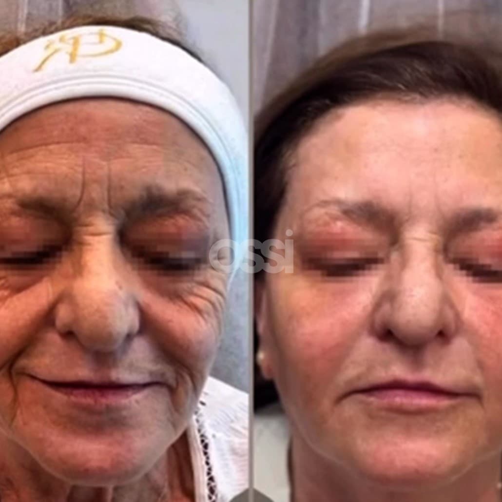 Botox Case 5