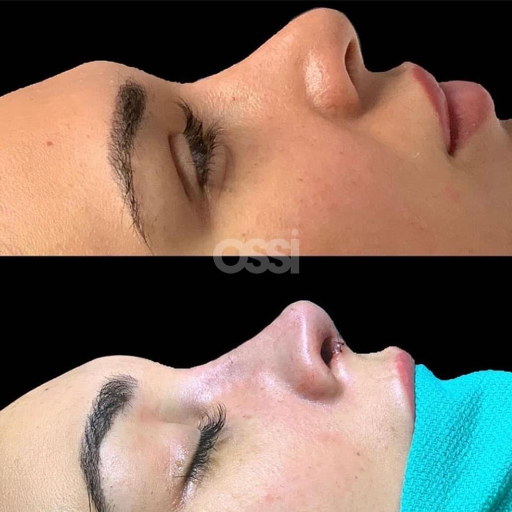 Rhinoplasty Case 5
