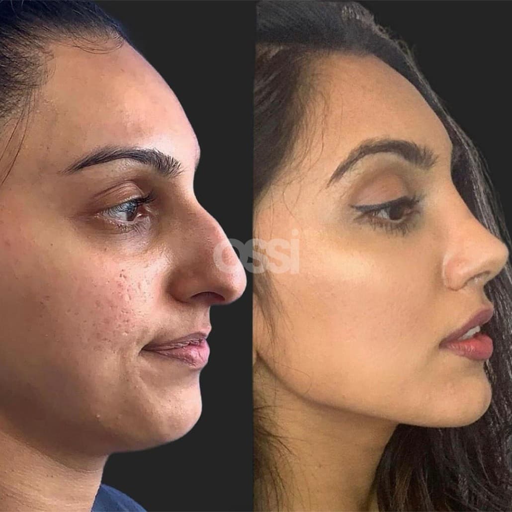 Rhinoplasty Case 6