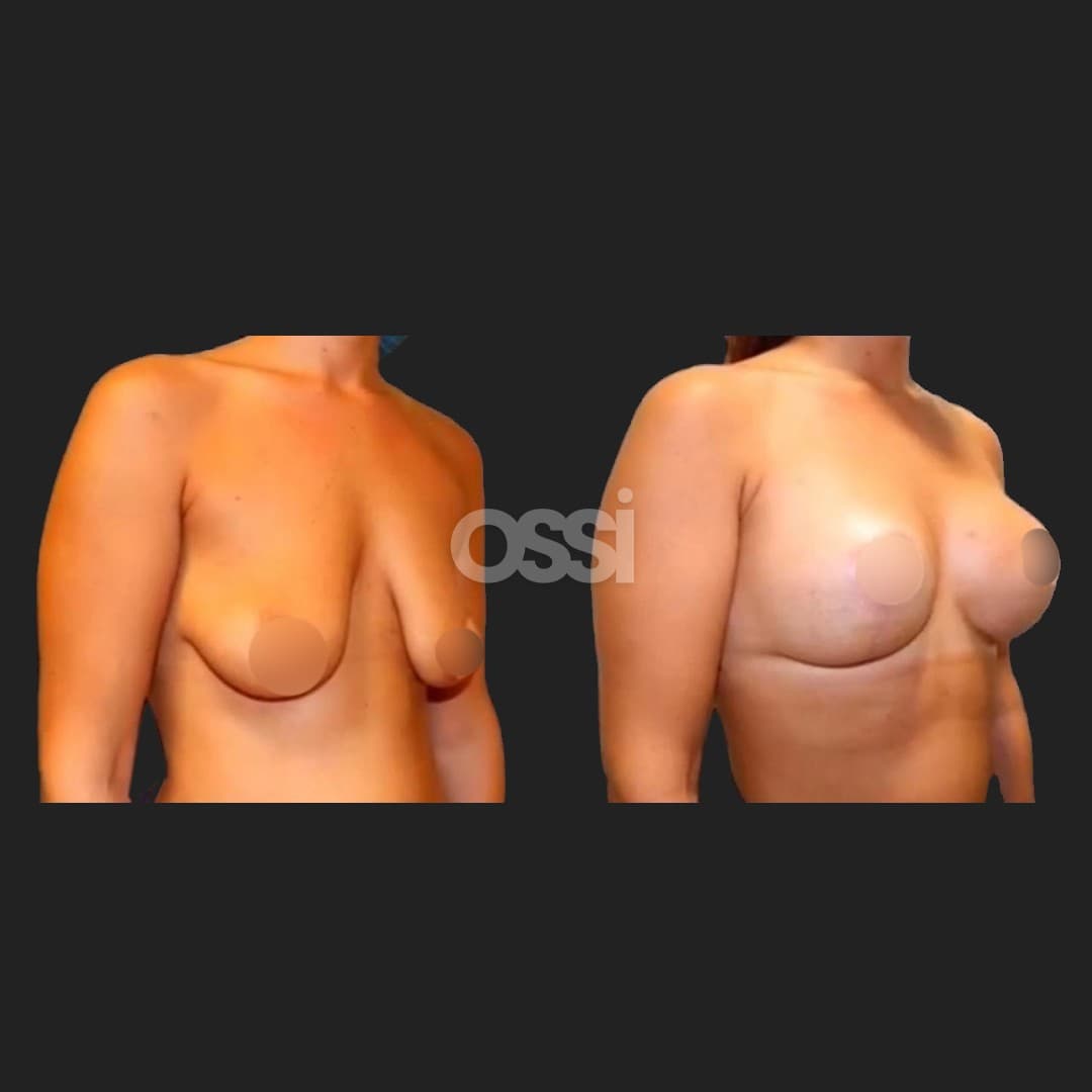 Breast Surgery Case 2