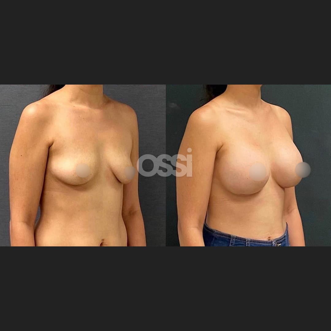 Breast Surgery Case 4