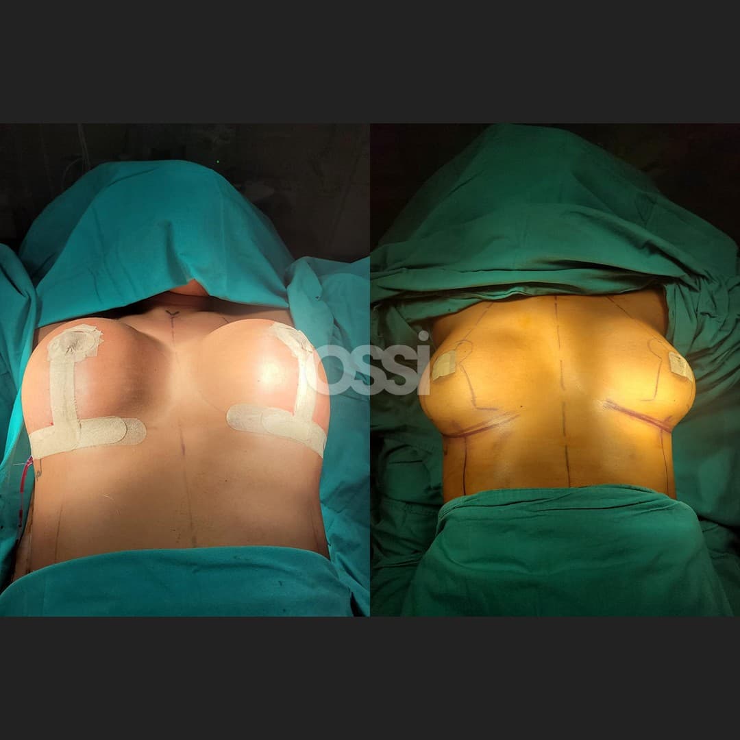 Breast Surgery Case 5