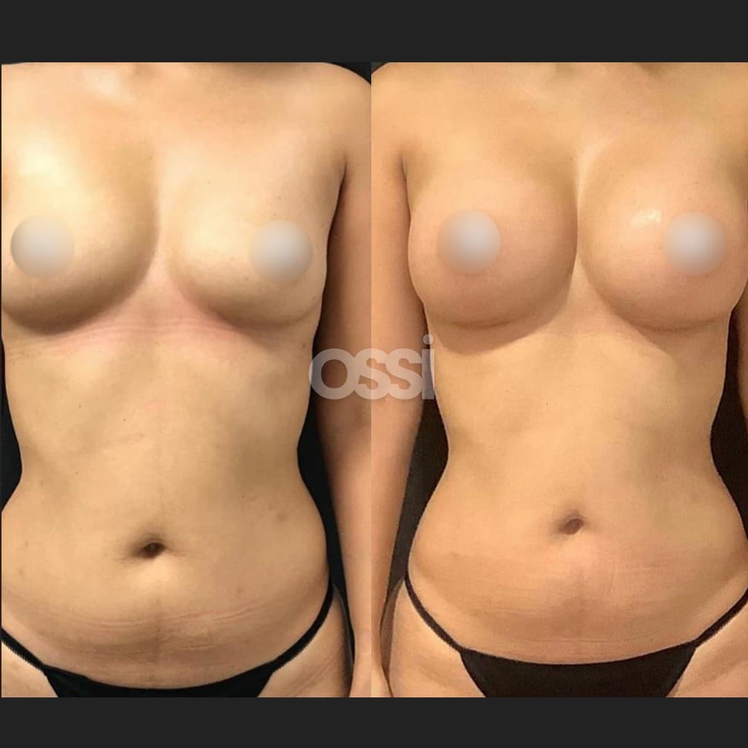 Breast Surgery Case 6