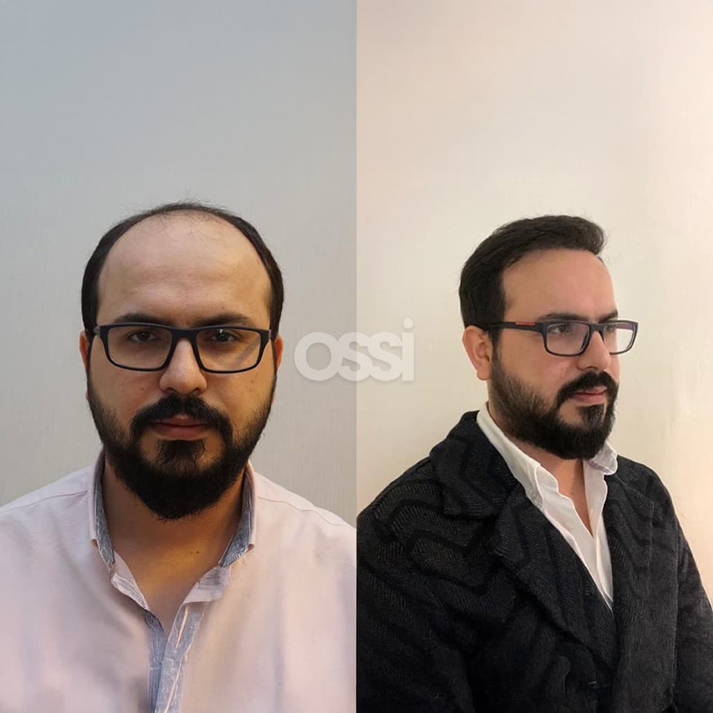 Hair Transplant Case 1