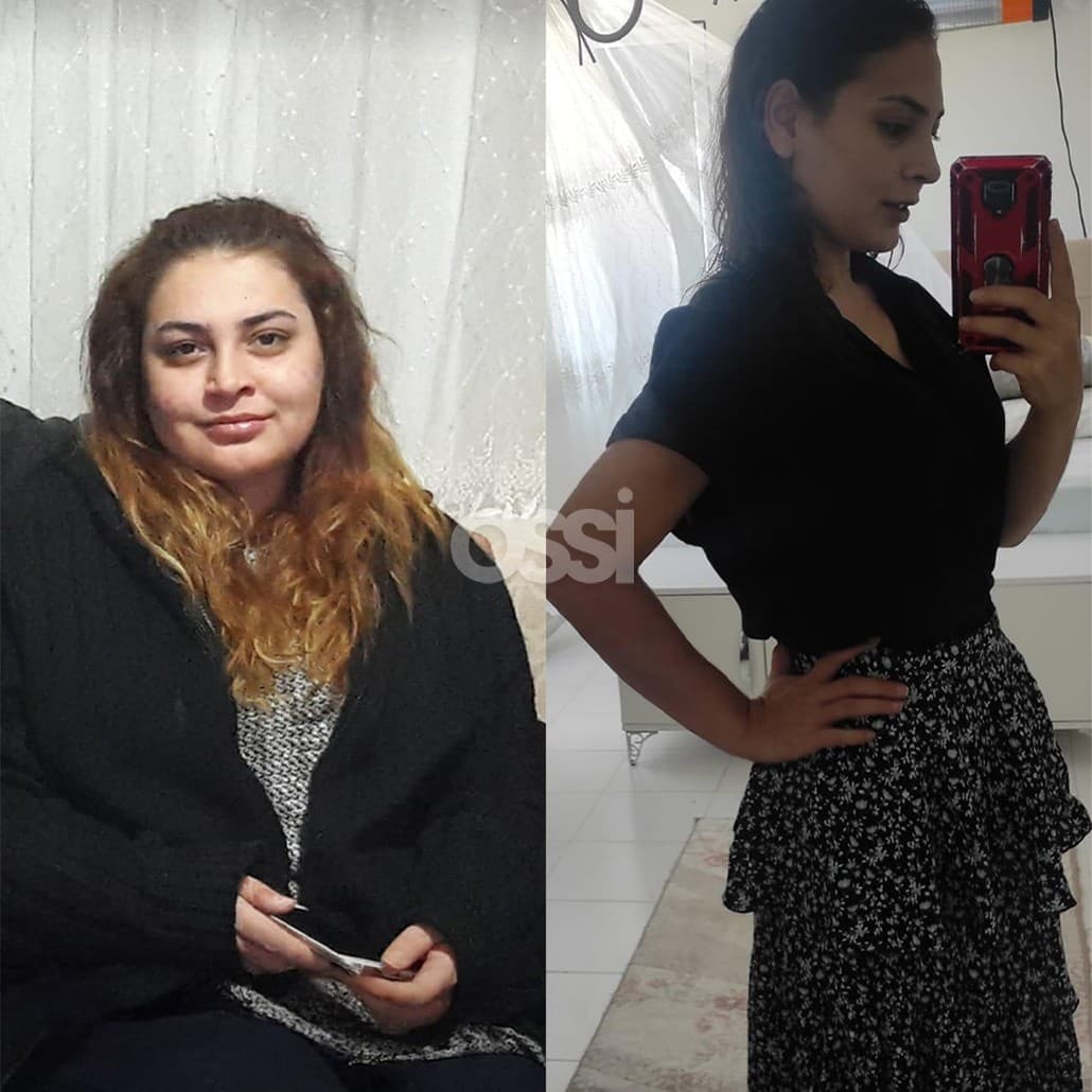 Obesity Surgery Case 1