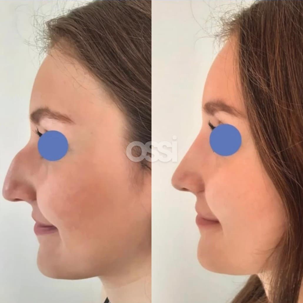 Rhinoplasty Case 10