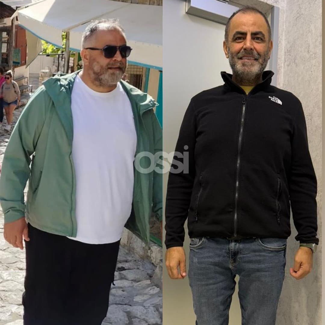 Obesity Surgery Case 10