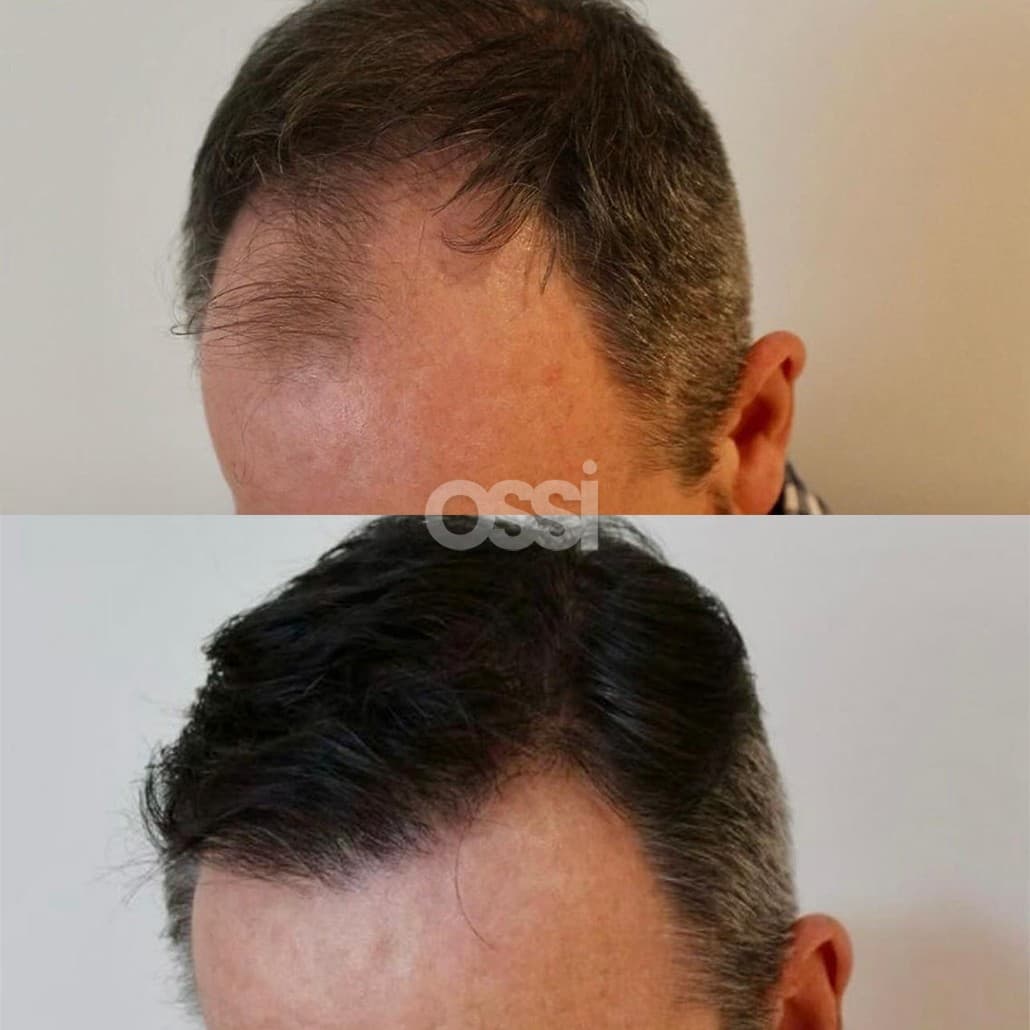 Hair Transplant Case 10