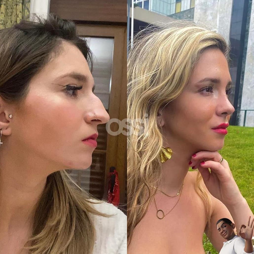 Rhinoplasty Case 11
