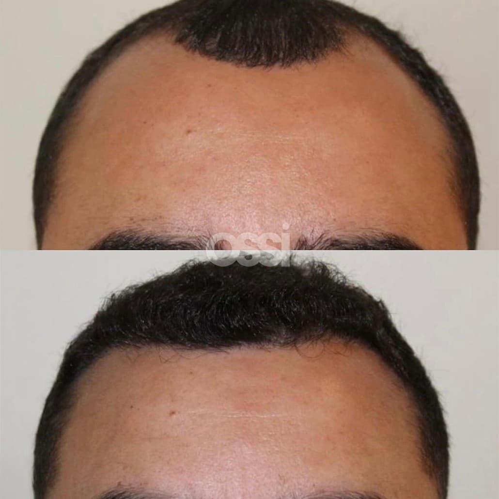 Hair Transplant Case 11