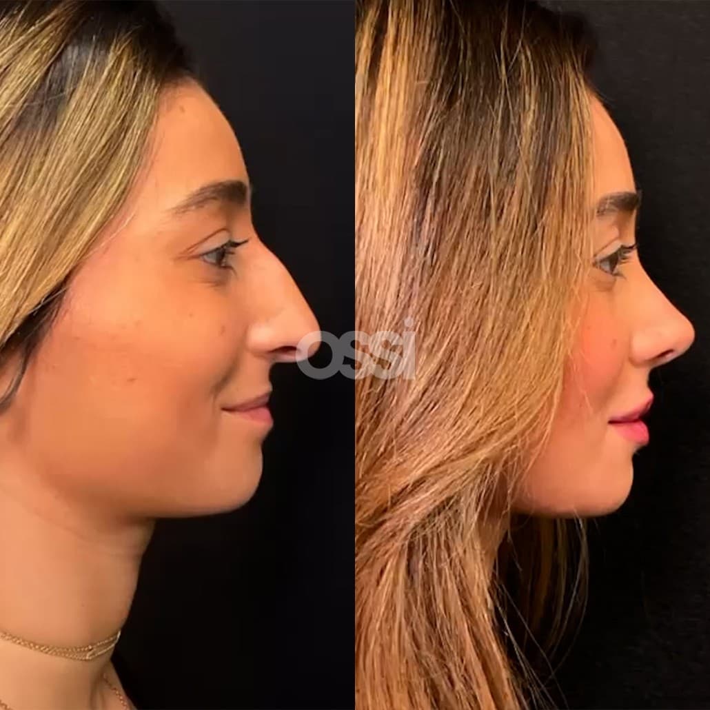 Rhinoplasty Case 12