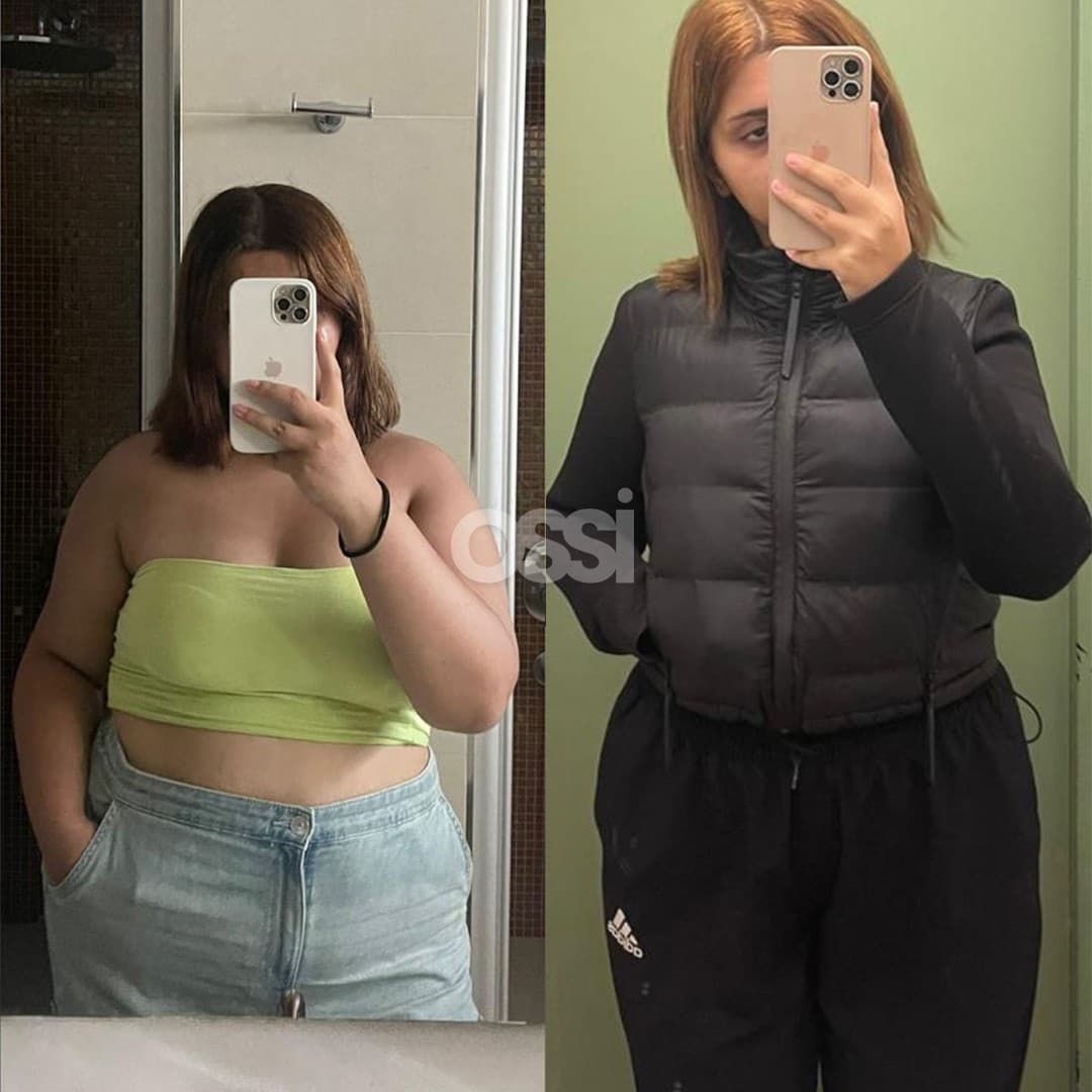 Obesity Surgery Case 12