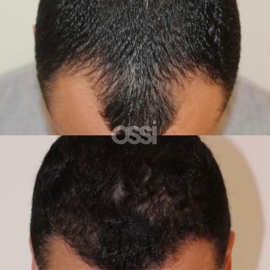 Hair Transplant Case 12