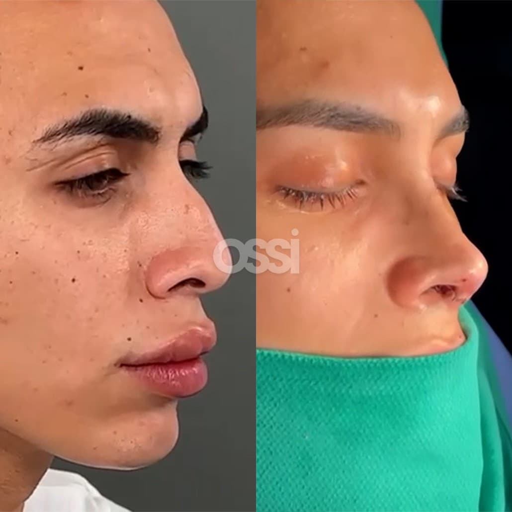 Rhinoplasty Case 13