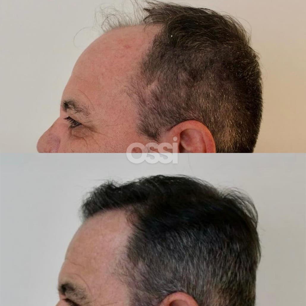 Hair Transplant Case 13