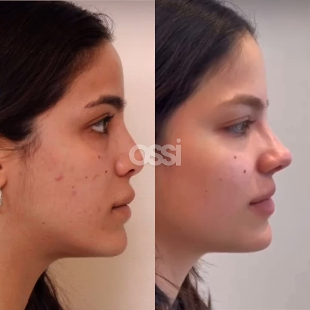 Rhinoplasty Case 14