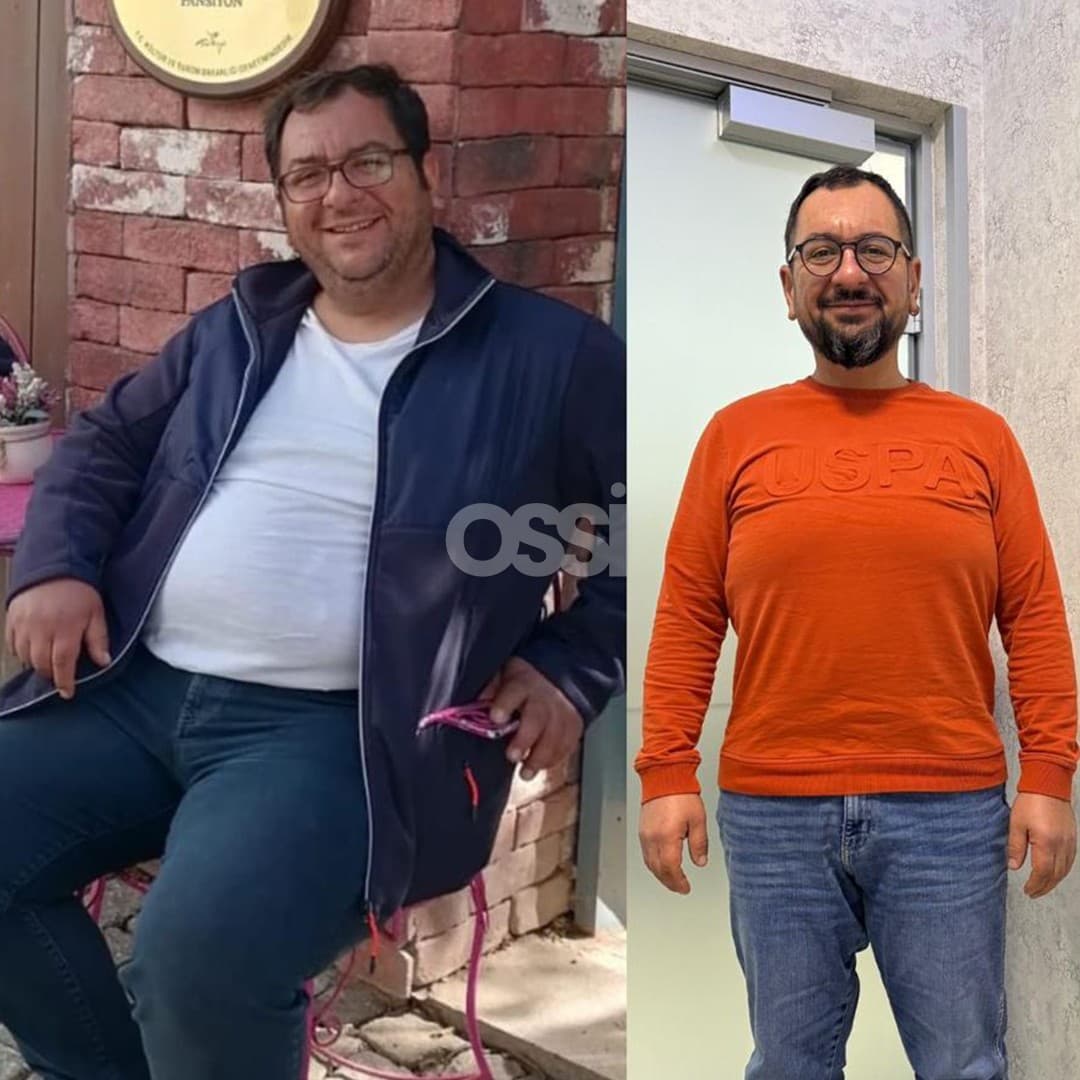 Obesity Surgery Case 14