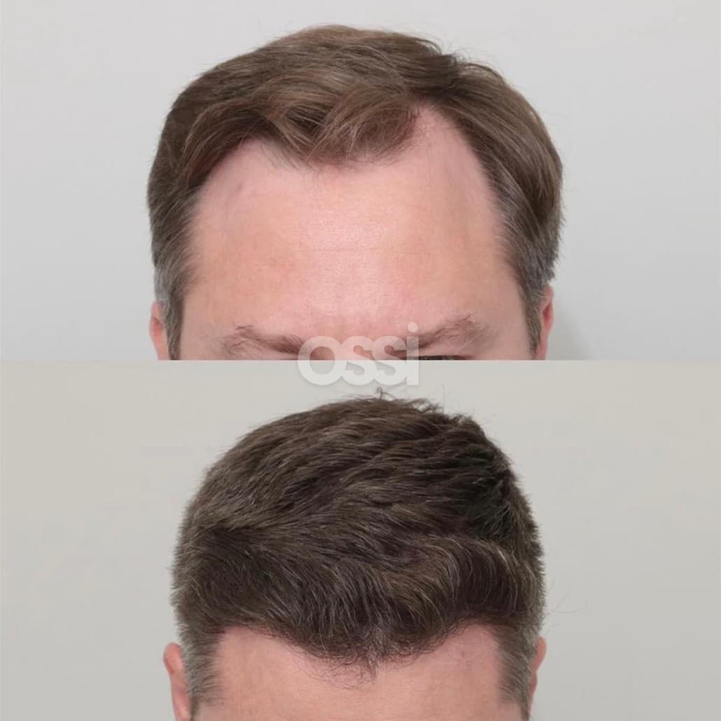 Hair Transplant Case 14