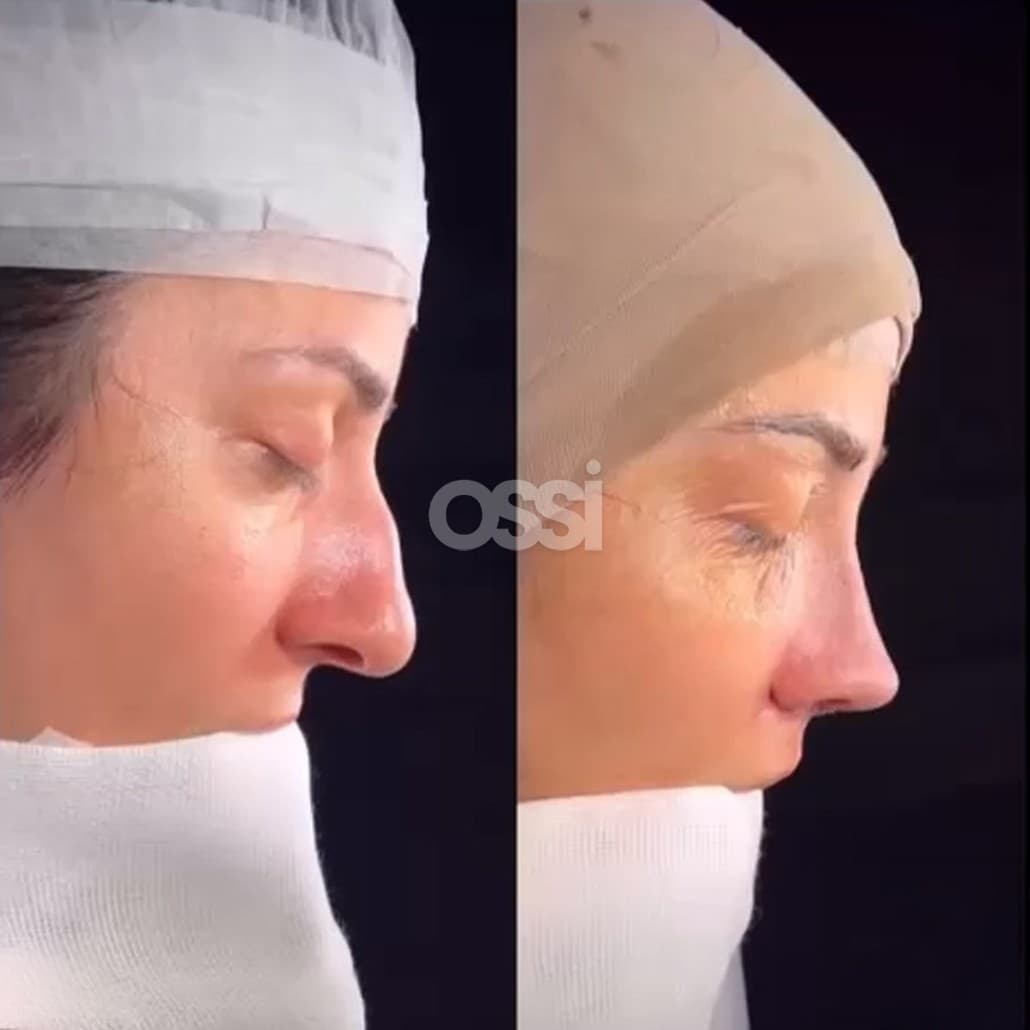 Rhinoplasty Case 15