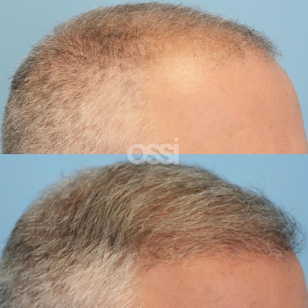 Hair Transplant Case 15