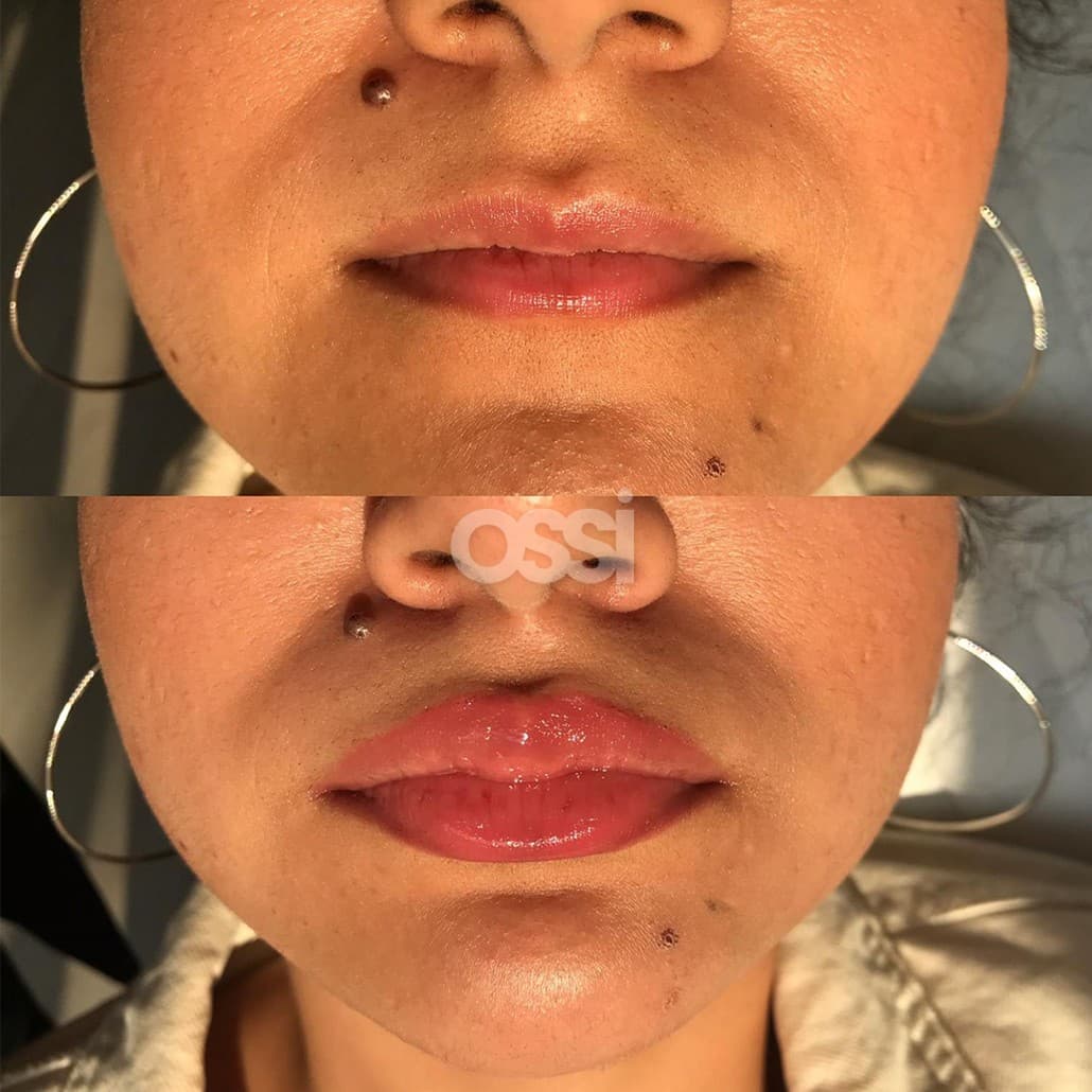 Filler Case 2