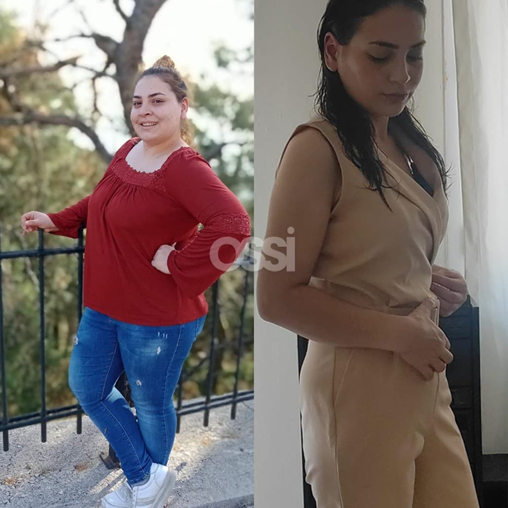 Obesity Surgery Case 2