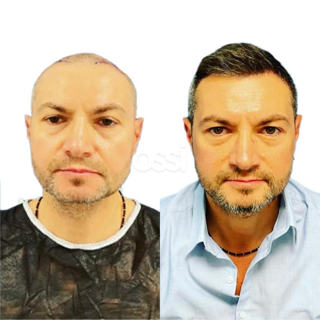Hair Transplant Case 2