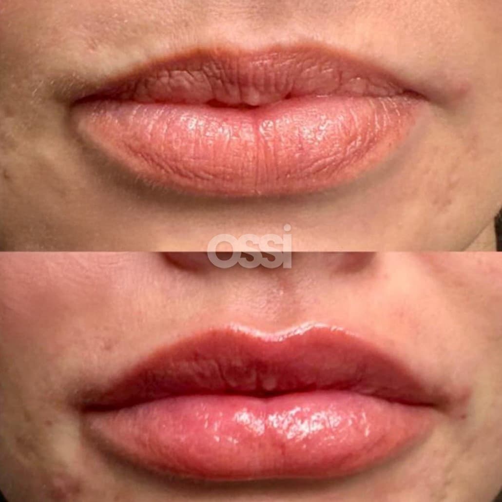Filler Case 3