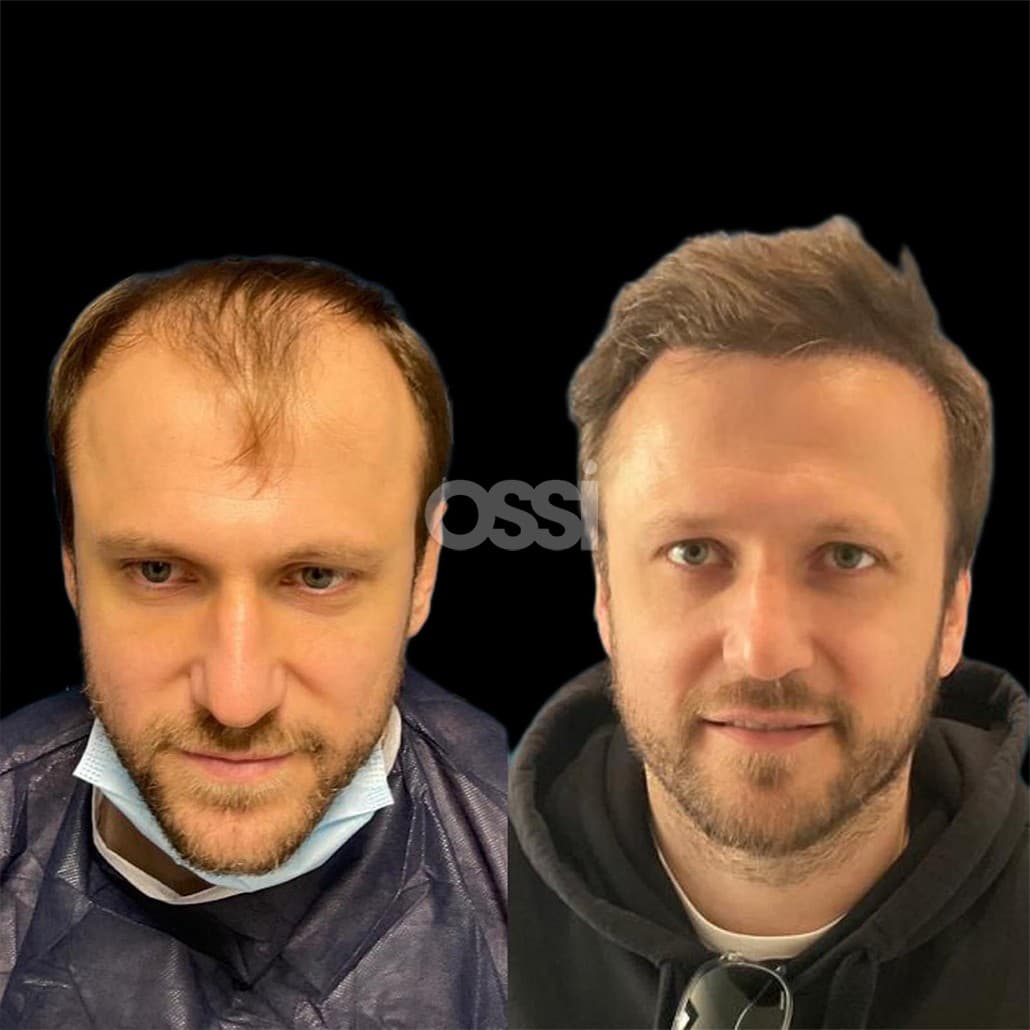 Hair Transplant Case 3
