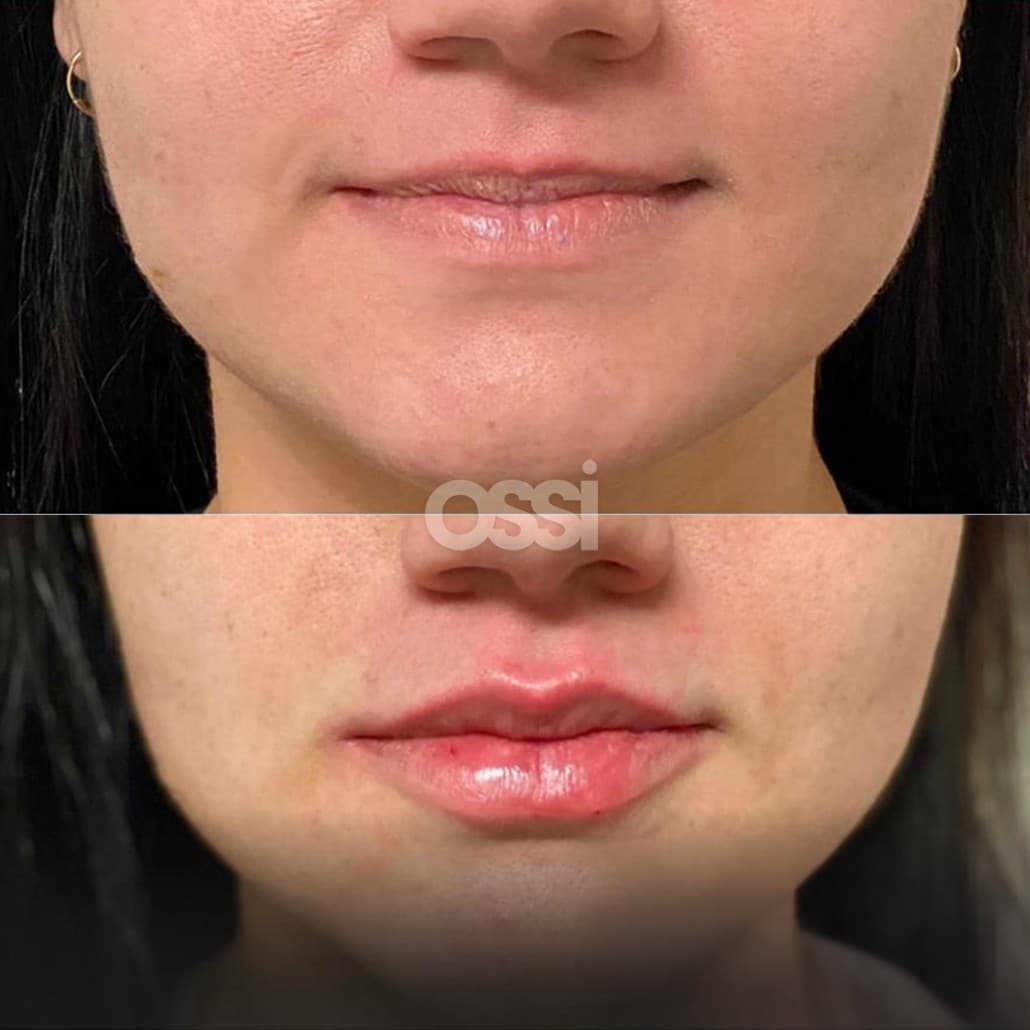 Filler Case 4