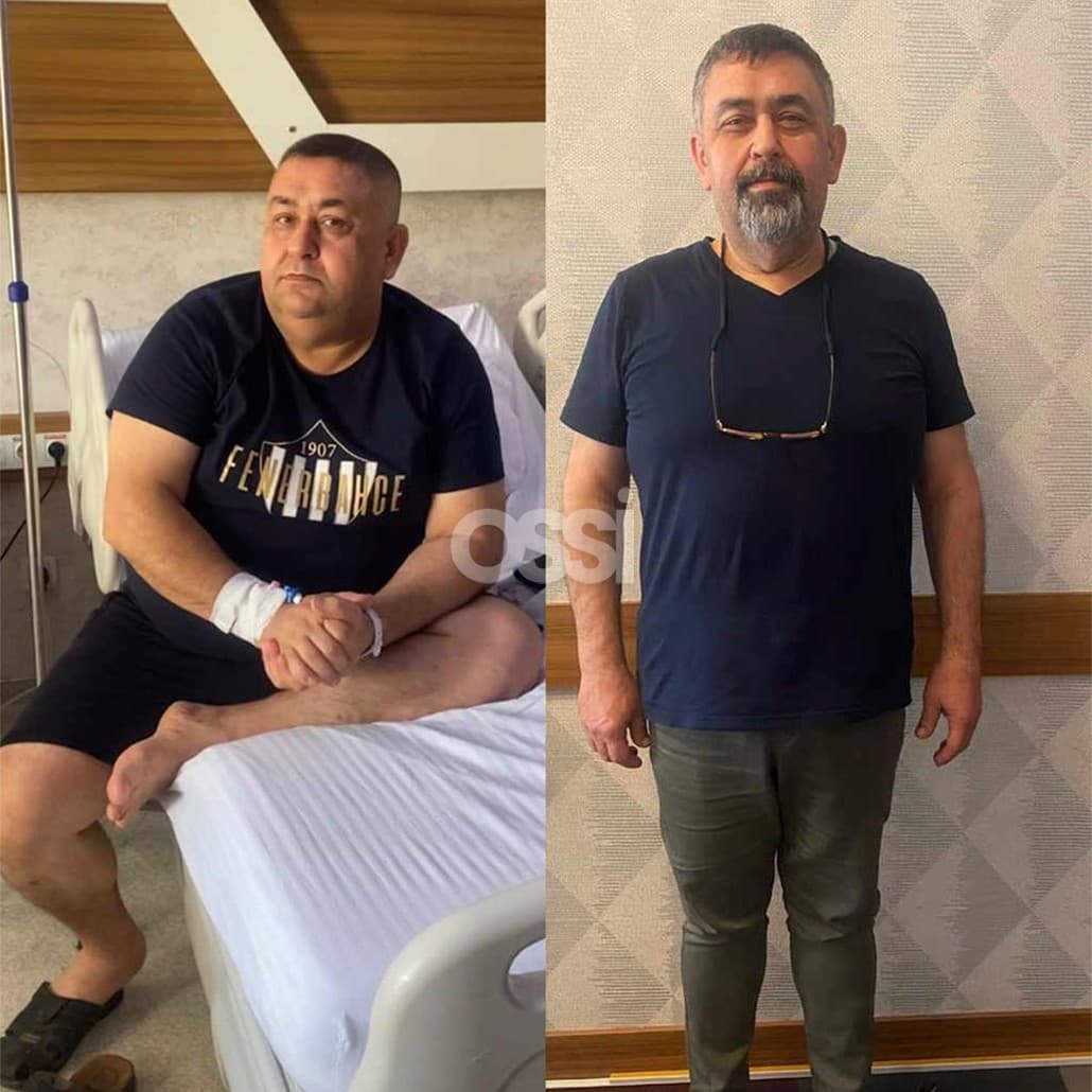 Obesity Surgery Case 4