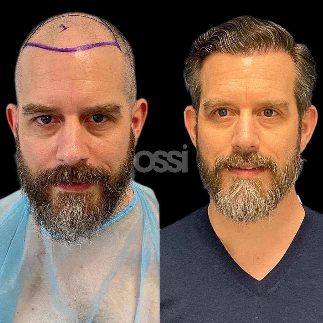 Hair Transplant Case 4