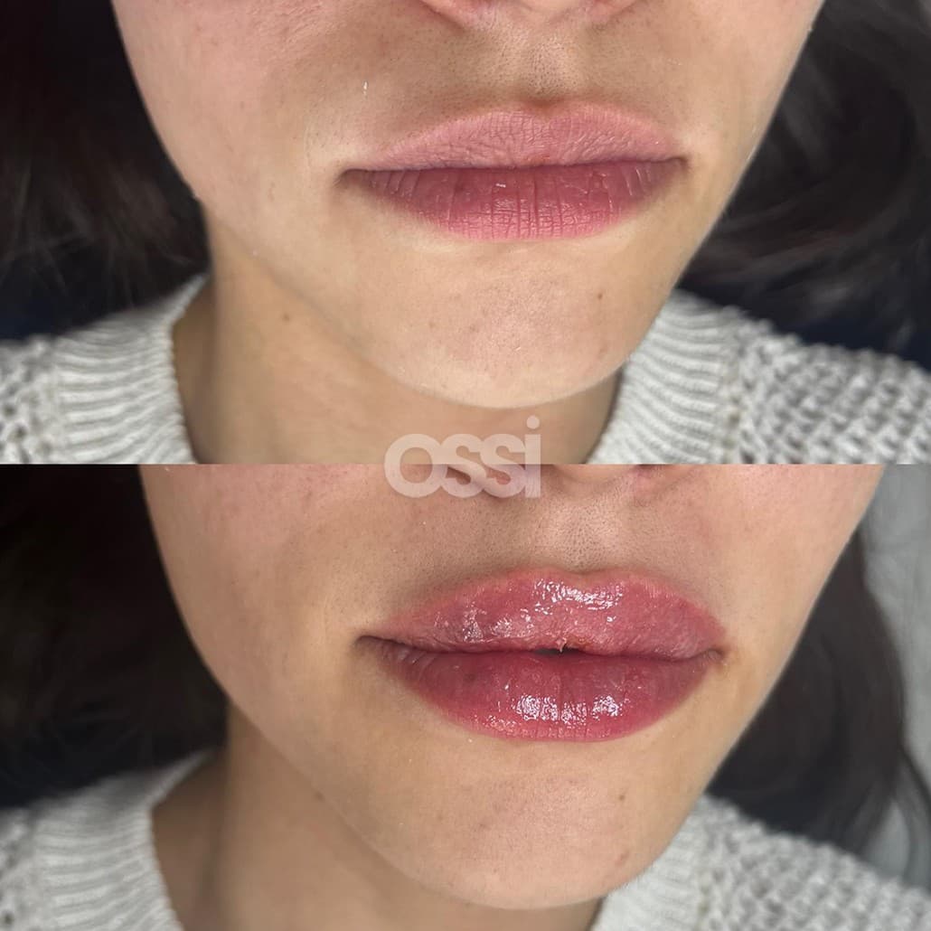 Filler Case 5