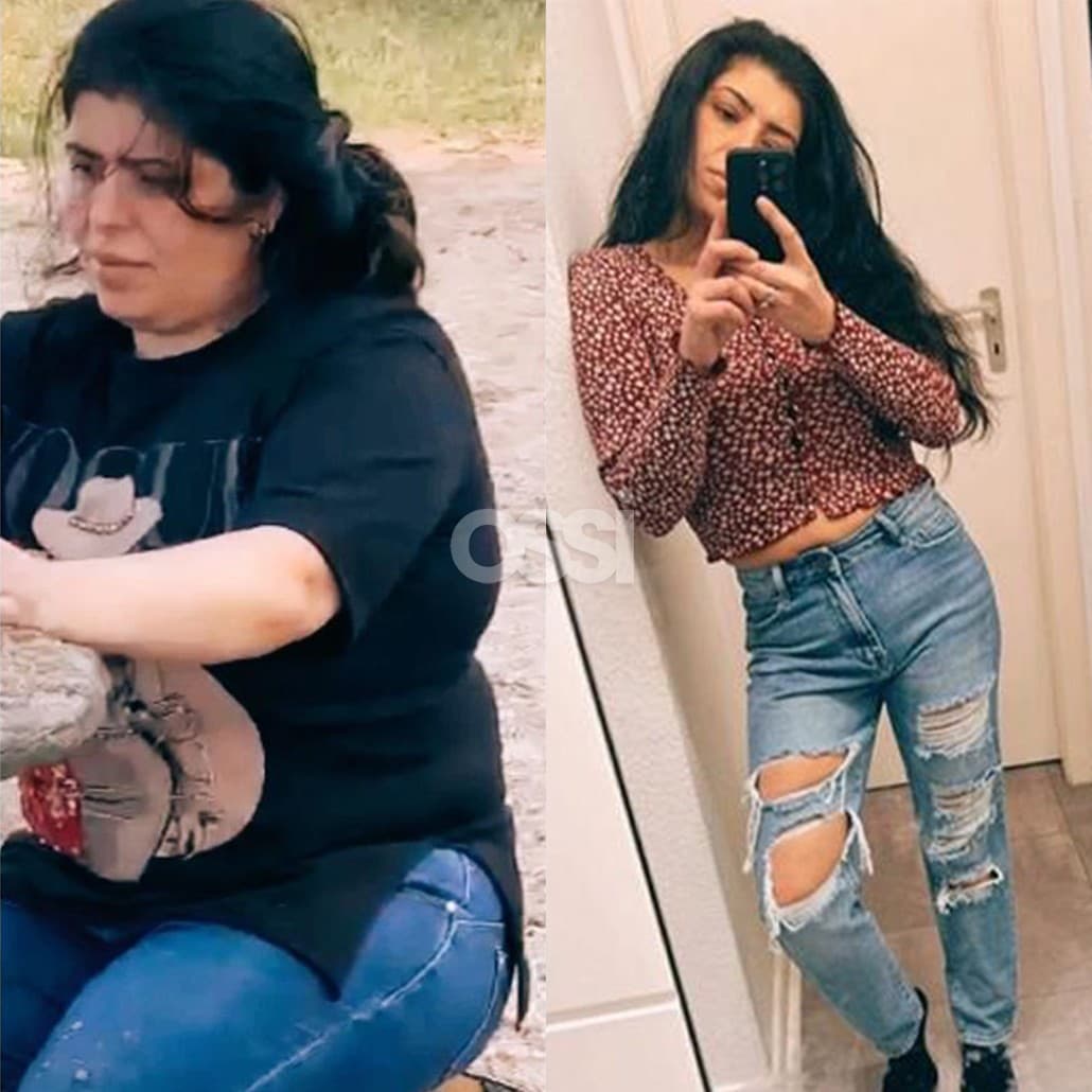 Obesity Surgery Case 5