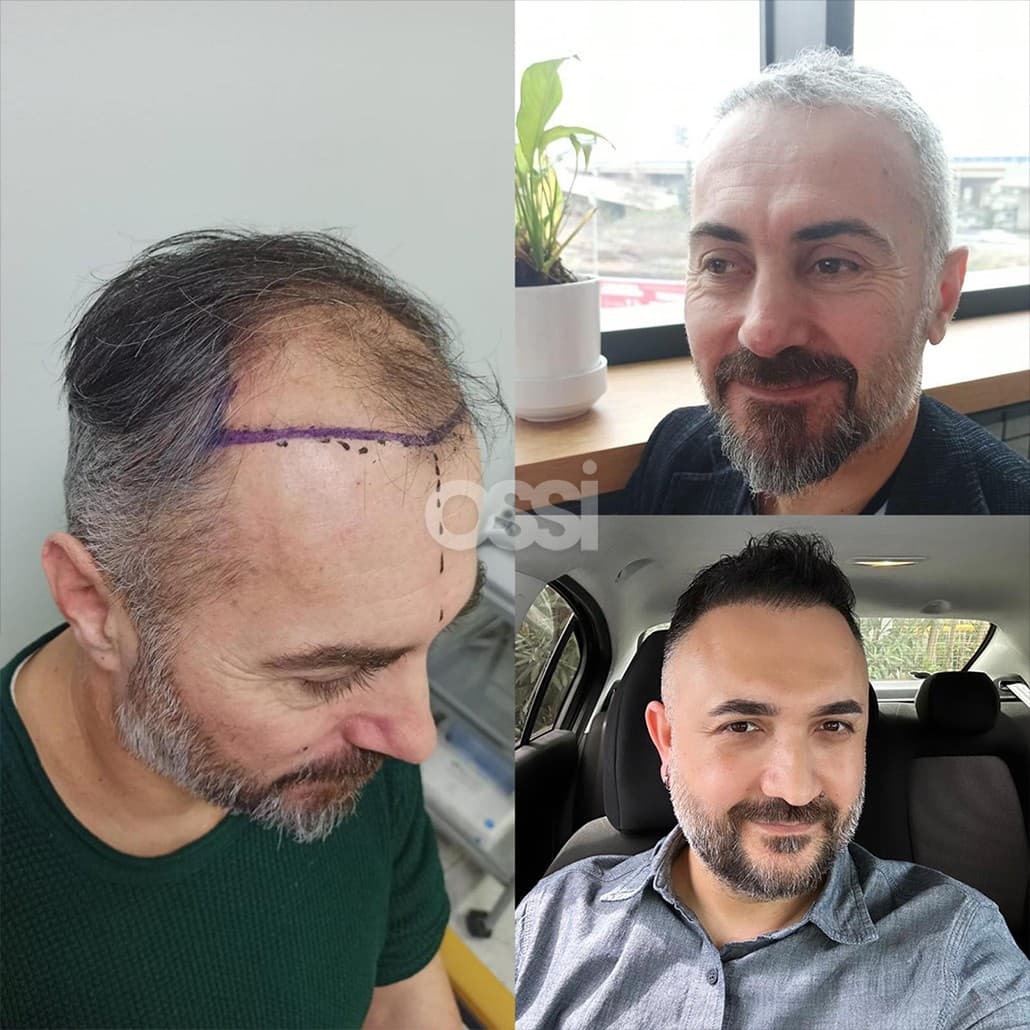 Hair Transplant Case 5