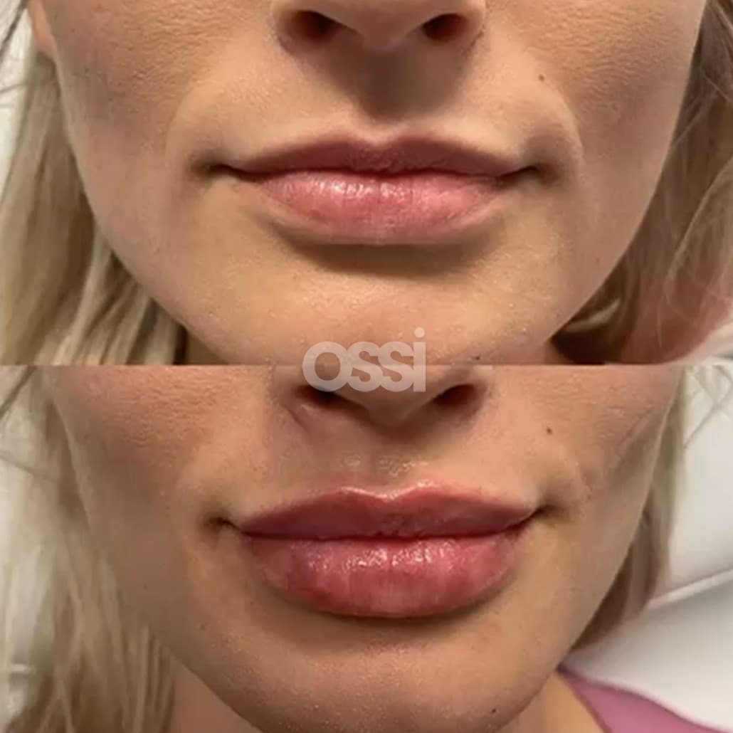 Filler Case 6