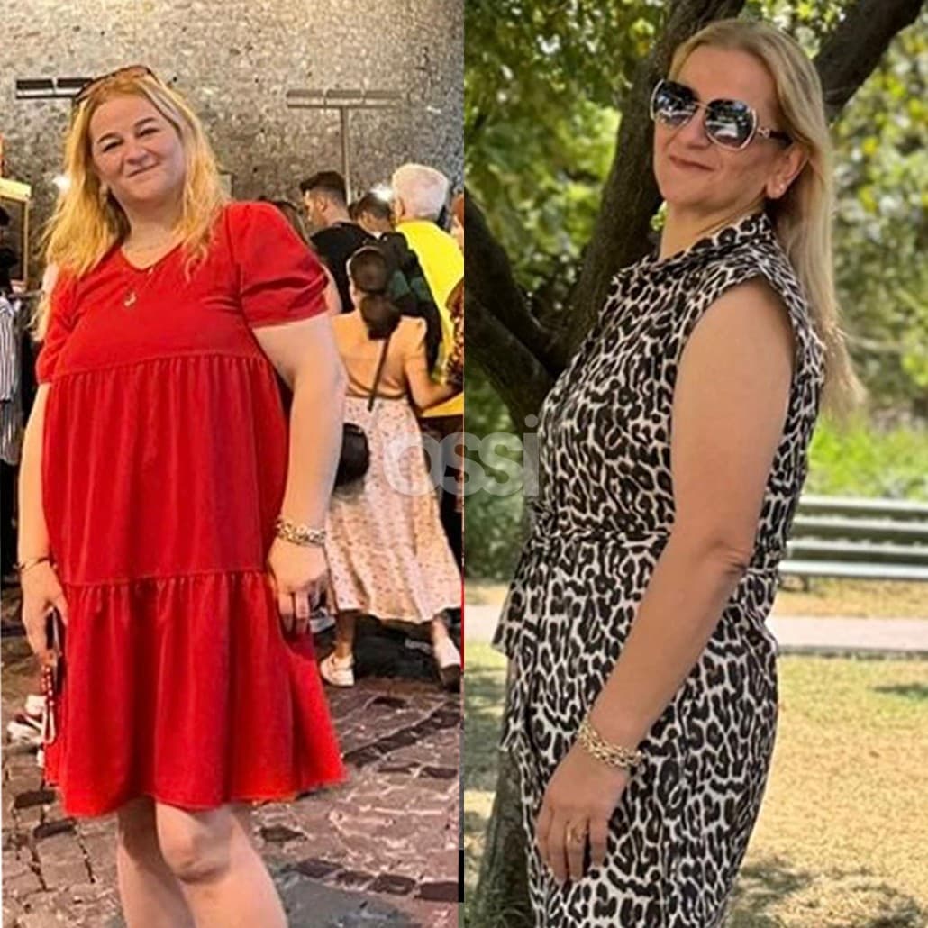 Obesity Surgery Case 6