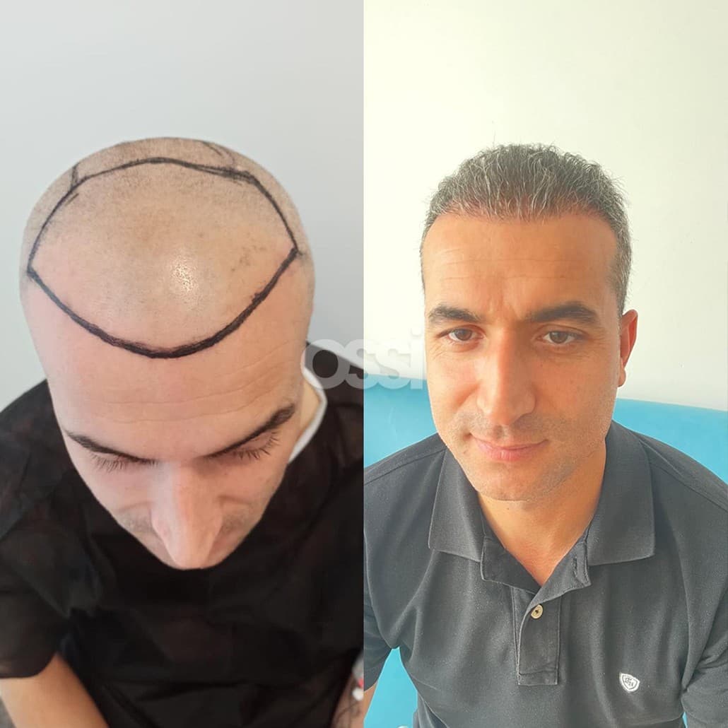 Hair Transplant Case 6