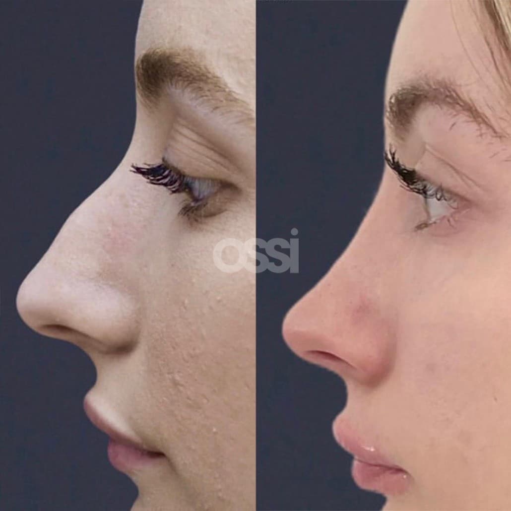 Rhinoplasty Case 7