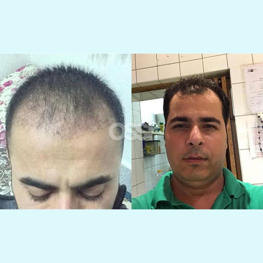 Hair Transplant Case 7
