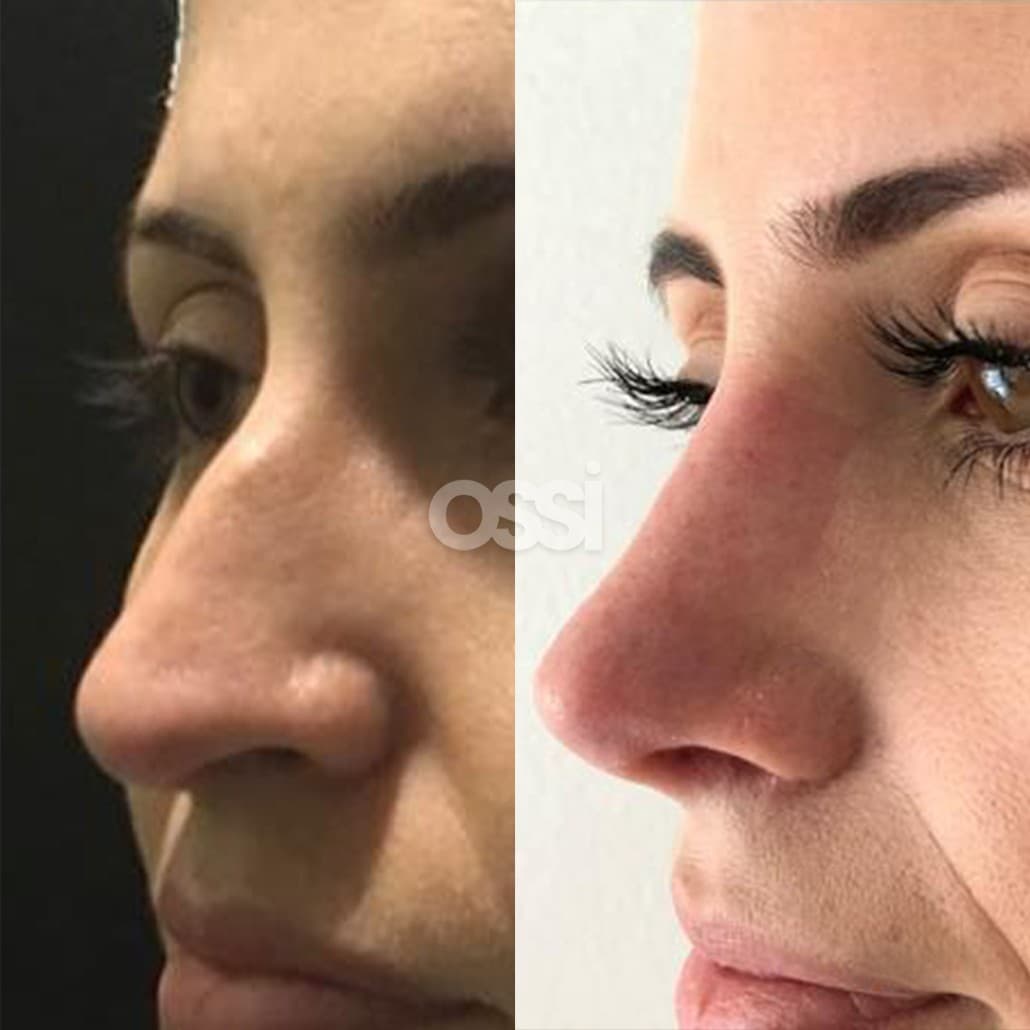 Rhinoplasty Case 8