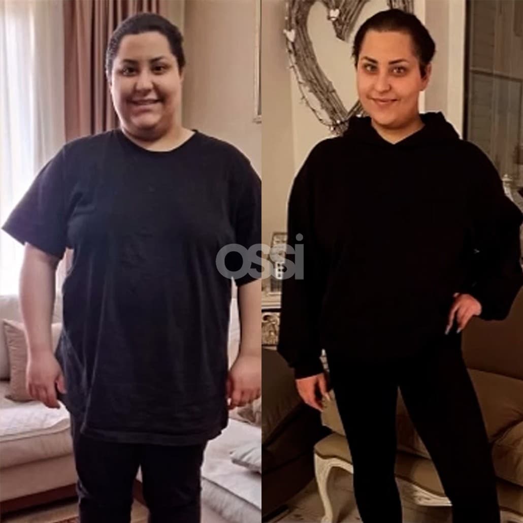 Obesity Surgery Case 8